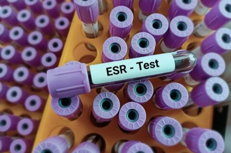 ErythrocyteSedimentationRate(ESR)